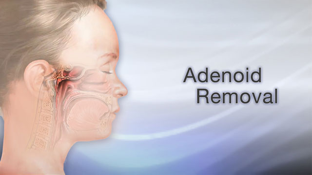 Adenoid removal Maybe your child snores a lot. Maybe your ...