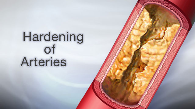 hardening-of-arteries-blood-is-the-fuel-that-keeps-your-body-alive-and