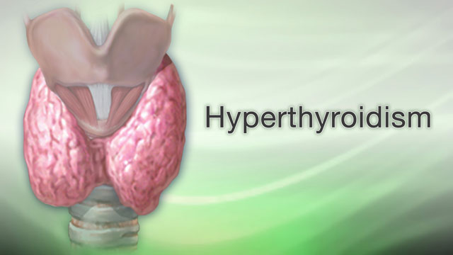 Hyperthyroidism You re Restless And Nervous You Feel Hungry All The hyperthyroidism-you-re-restless-and-nervous-you-feel-hungry-all-the