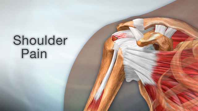 shoulder-pain-swelling-damage-or-bone-changes-around-the-rotator-cuff