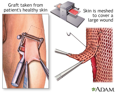 Stem Cell Transplants On Facial Areas 88