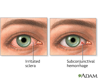 Pregnancy Smartsite Eye Redness