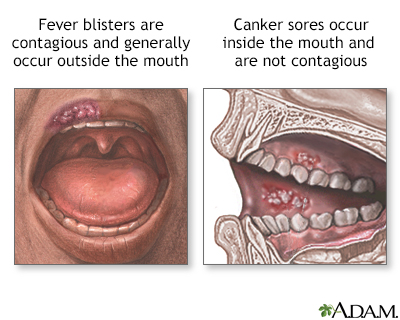 Mouth Sores