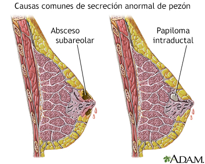 Papiloma intraductal en el seno, Fibroadenoma de seno dicționar wikipedia