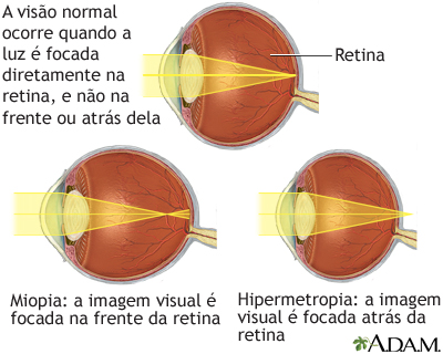 hipermetropia apare ca urmare doi ochi viziune diferită