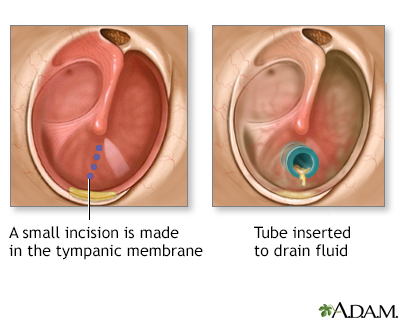 normal tympanic membrane labeled