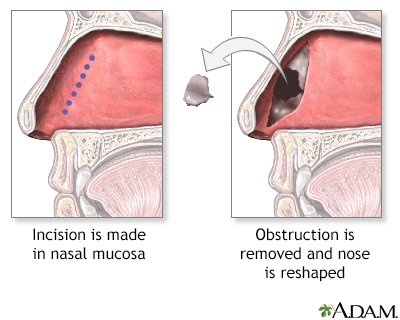 HIE Multimedia - Rhinoplasty