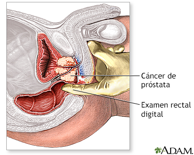 Cáncer de próstata