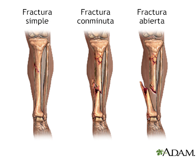 Tratamiento de fracturas de huesos - serie