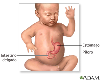 Estenosis pilórica infantil - serie