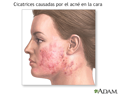 Cirugía para suavizar la superficie de la piel (dermabrasión) - Serie - Indicaciones