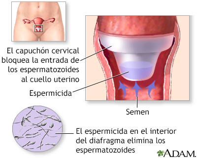 Capuchón cervical