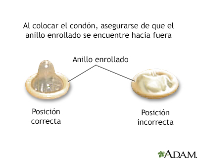 Colocación del condón - serie