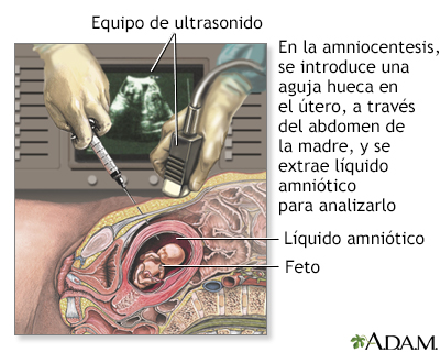 Amniocentesis