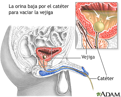 Cateterismo vesical en el hombre