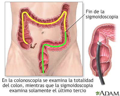 Colonoscopia