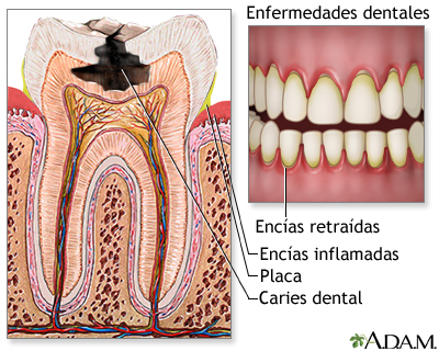 Gingivitis