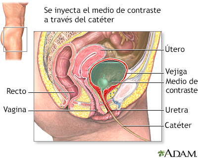 Cistouretrograma de eliminación