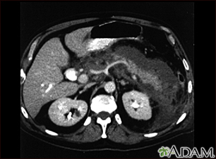 Pancreatitis, aguda - TC