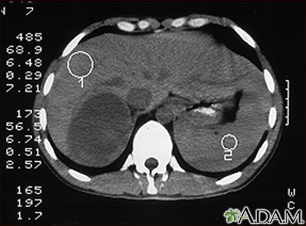 Tumor suprarenal - TC