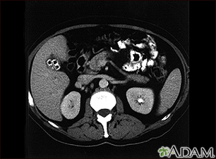 Colecistolitiasis