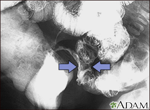 Enfermedad de Crohn - rayos X