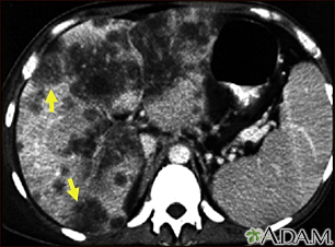 Cáncer hepatocelular - TC