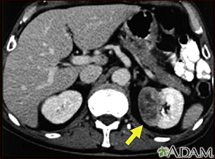 TC - tumor del riñón