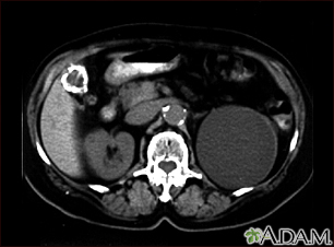 Quiste renal con cálculos biliares - TC