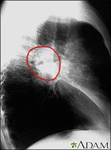 Cáncer de pulmón - radiografía lateral del tórax