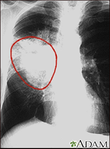 Cáncer de pulmón - radiografía frontal del tórax