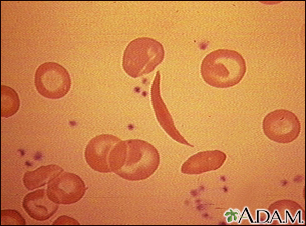 Glóbulos rojos drepanocíticos