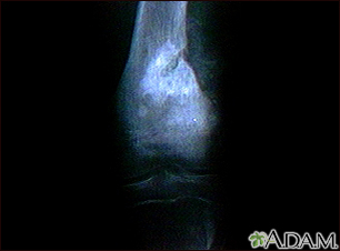 Rayos X - un sarcoma osteogénico