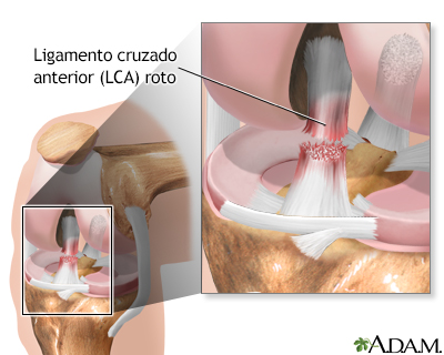 Cómo lidiar con una rodilla dislocada (con imágenes)