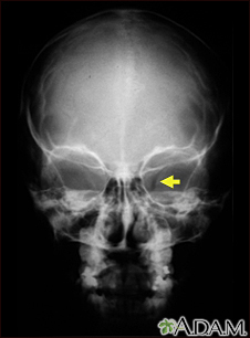 Neurofibromatosis I - agrandamiento de la abertura óptica