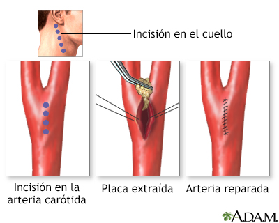 Procedimiento