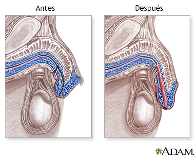 Hipospadias - Cuidados postoperatorios