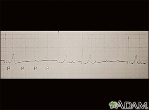 Registro del ECG durante un bloqueo auriculoventricular