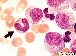 Vista microscópica - leucemia mielocítica crónica