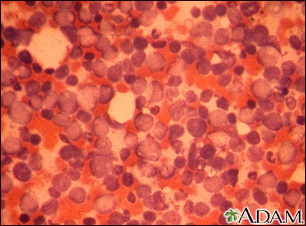 Leucemia mielocítica crónica