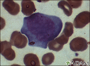 Mononucleosis - microfotografía de células