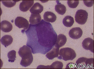 Mononucleosis infecciosa #3