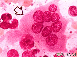 Osteoclasto