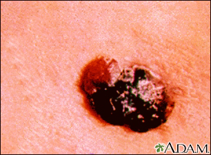 Cáncer de piel - melanoma multicolor en relieve