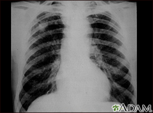 Neumoconiosis del minero - etapa II