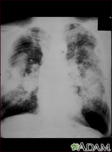 Neumoconiosis en trabajadores del carbón, complicada