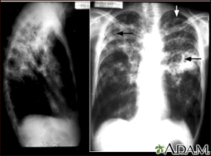 Tuberculosis, avanzada - radiografía de tórax