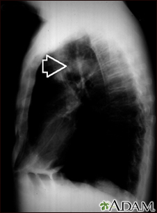 Masa pulmonar - Vista lateral de la radiografía de tórax