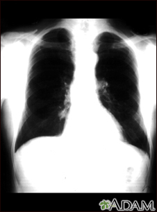 Nódulo pulmonar - Vista frontal de la radiografía de tórax