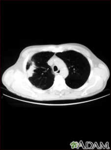 Pulmón con cáncer de células escamosas - Tomografía computarizada